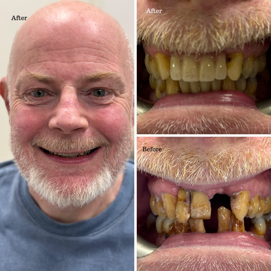 Dental implant before and after result at Ardent Smile Clinic