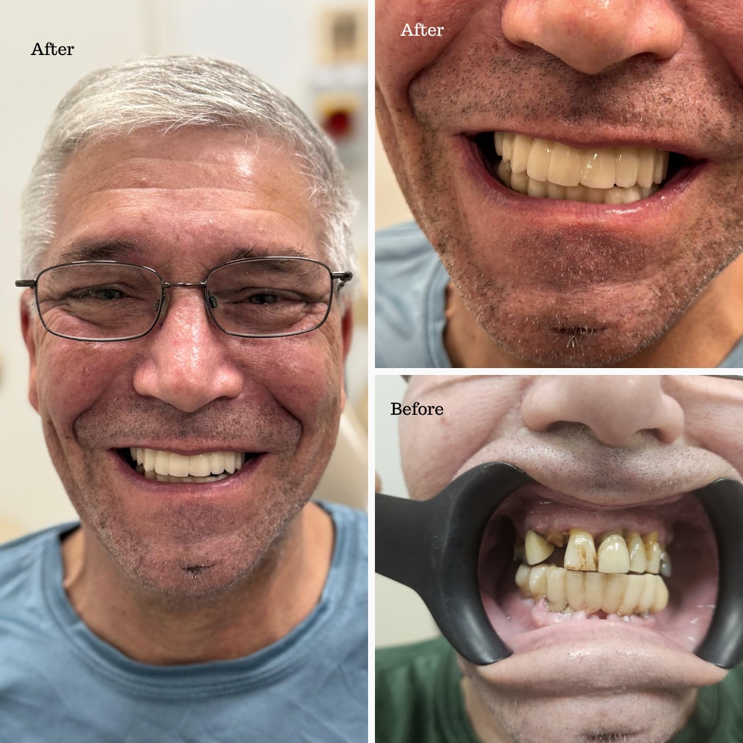 Dental implant before and after result at Ardent Smile Clinic