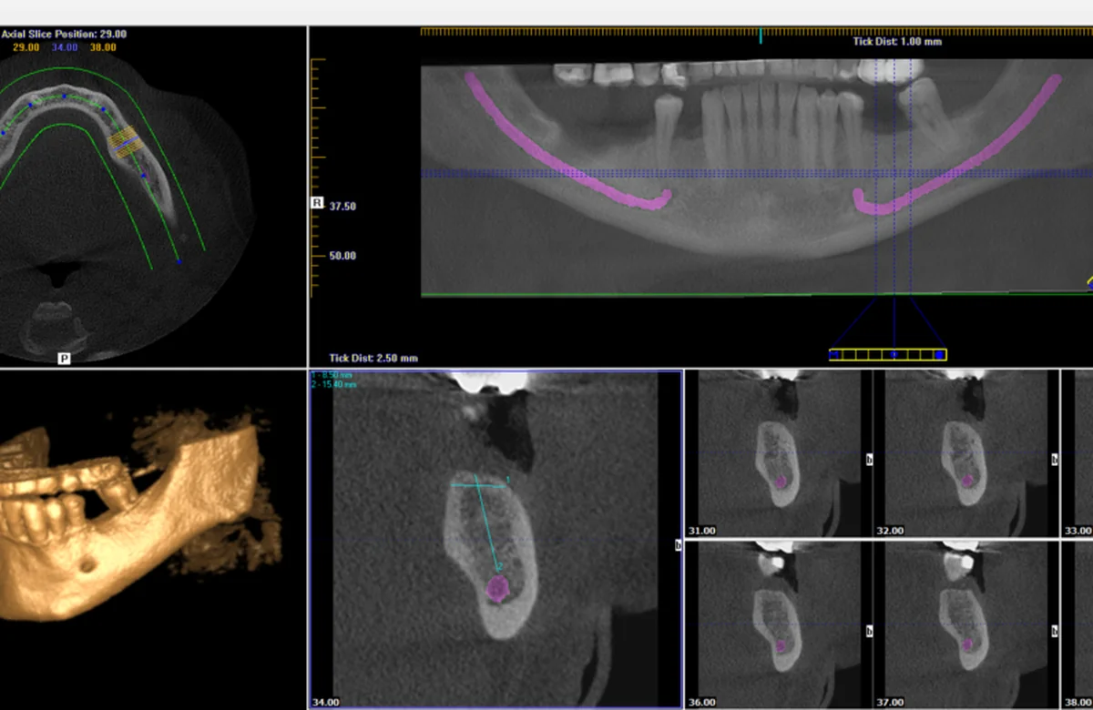 CBCT 3D scan used for precise dental implant planning at Ardent Smile Clinic